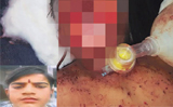 Cellphone blast victim needs multiple surgeries